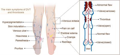 A systematic evaluation and meta-analysis of early prediction of post-thrombotic syndrome